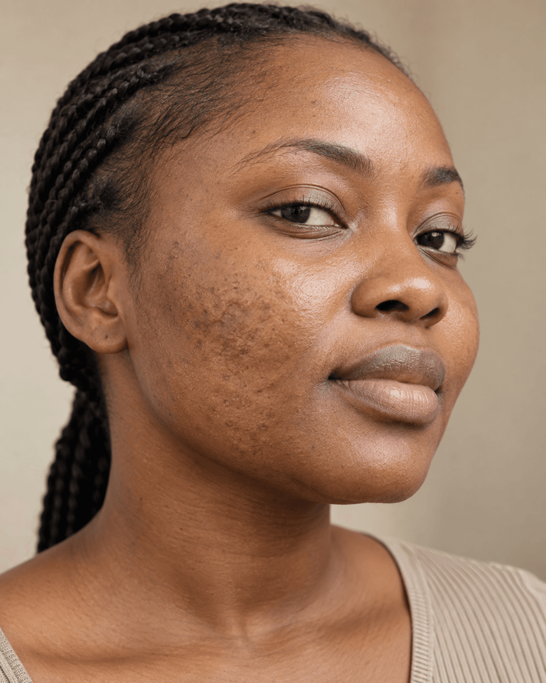Illustrative close-up of post-acne textural scarring on melanin-rich skin