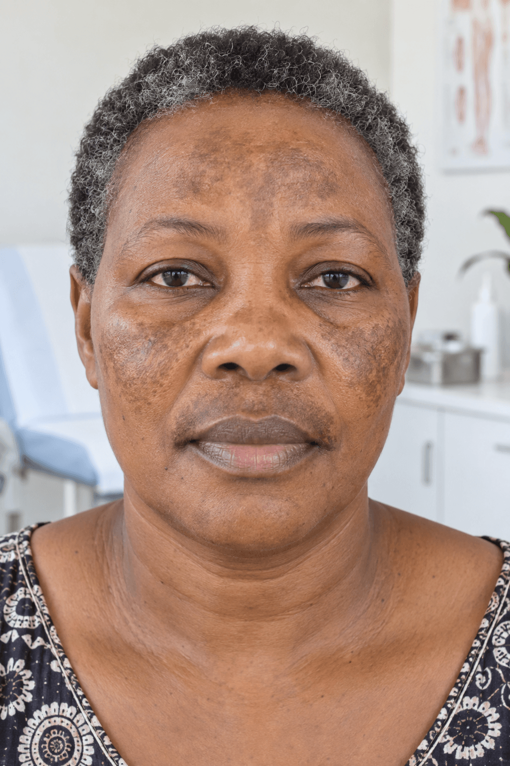 Illustrative close-up of clearly visible facial melasma patches on melanin-rich skin
